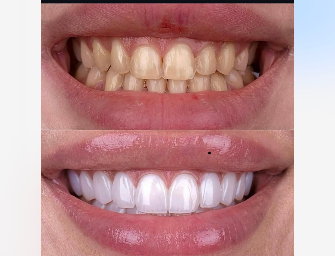 Résultat clinique avant-après réalisé par le Dr Krisztina Magyar chez Avenue Dental à Budapest